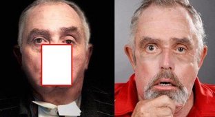 64-летний дедуля стал самым старым человеком в мире, которому пересадили новое лицо (6 фото)