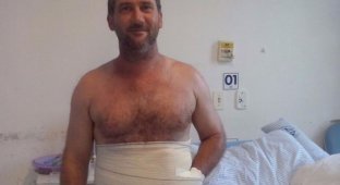 Хирурги спасли руку мужика, зашив ее в живот (2 фото)