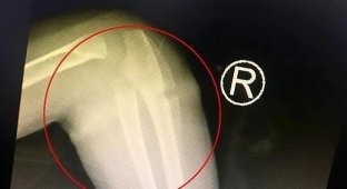 Китайским врачам пришлось хирургически удалять резиновое кольцо, вросшее ребенку под кожу (6 фото)