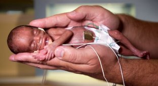 Младенец выжил после аборта, вопреки всем