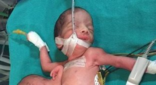 Жуткие кадры! В Индии родился младенец с двумя головами и выжил (5 фото)
