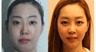 Пластическая хирургия в Южной Корее (10 фото)