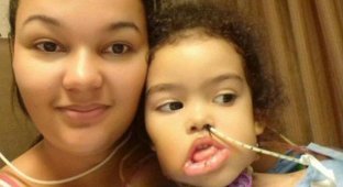 Врачи удалили с лица трехлетней девочки опухоль массой болье двух килограмм (6 фото)