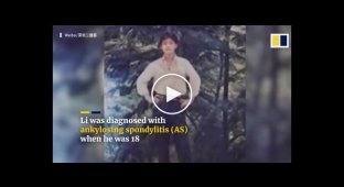 Китаец 28 лет был сложен пополам из-за болезни Бехтерева – но врачи его «разогнули»