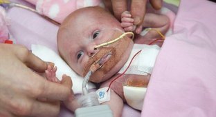 Британские врачи спасли девочку, родившуюся с сердцем вне тела (8 фото + 1 видео)