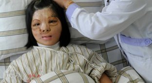Китайские врачи сделали новое лицо девушке из ее груди (6 фото) (жесть)