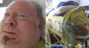 Из-за серьезной болезни мужчине приходится жить в специальном аппарате уже больше 60 лет (8 фото + 1 видео)