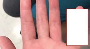 Опухший палец может быть признаком туберкулёза (2 фото)