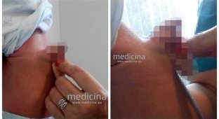 В Азербайджане родился мальчик с пенисом-паразитом на спине (4 фото)