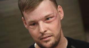 Невероятные результаты пересадки лица, сделанной парню после того, как он выстрелил себе в лицо (13 фото)