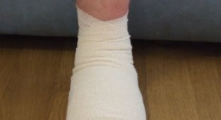 Врачи пересадили англичанину большой палец с ноги на руку (4 фото)
