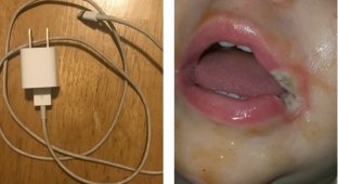 Ребёнок зacyнул зарядное устройство себе в рот и это превратилось в настоящий кошмар (8 фото)
