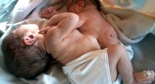В Индии младенец родился с головой и руками близнеца-паразита, торчащими из груди (2 фото)