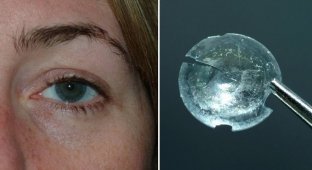 Из века женщины достали контактную линзу, которая пробыла там почти 30 лет (3 фото)