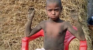 Врачи не знают, как помочь каменеющему мальчику из Бангладеш (5 фото)
