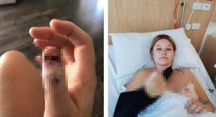 Её привычка грызть ногти привела к ампутации пальца (4 фото)