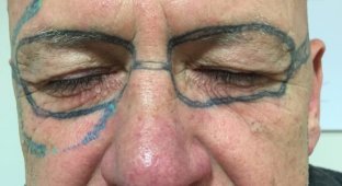 Мужчина решил избавиться от татуировки в виде очков на своём лице (4 фото)