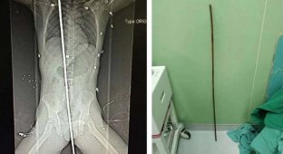 Строитель из Китая выжил после того, как упал на 2-метровую арматуру (4 фото)