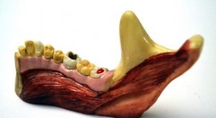 Аппетитные челюсти со следами серьезного заболевания десен (3 фото)