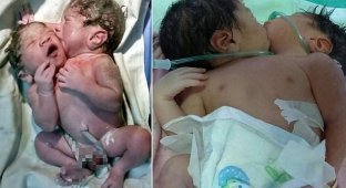 Ребенок с двумя головами родился в Индии (1 фото + 1 видео)