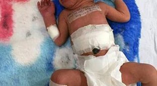 Индийский младенец родился со второй головой на животе (4 фото)