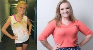 Истории девушек, победивших анорексию и их фотографии в стиле 'до и после' (15 фото)