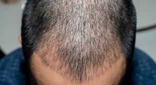Пересадка волос опасна для здоровья (4 фото)