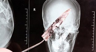 Китаец прожил четыре года с ножом в черепе (5 фото)