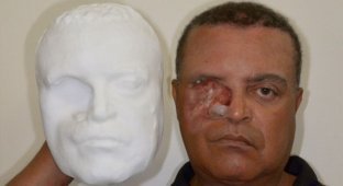 Бразильцу изготовили лицевой протез с помощью смартфона и 3D-принтера (3 фото)