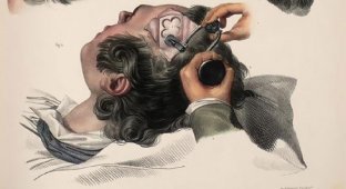 Шокирующие иллюстрации из руководства по хирургии XIX века (18 фото)