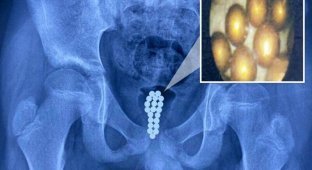 В Китае врачи вытащили из пениса мальчика 20 магнитных шариков (4 фото)
