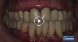 Имплантация зубов (жесть)