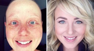 Люди, победившие рак: поразительные фото до и после (47 фото)