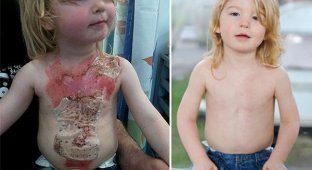 Ребенка избавили от ожогов благодаря спрей-коже (5 фото)