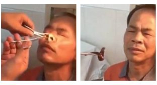 Из носа китайца извлекли огромную пиявку (3 фото + 1 видео)