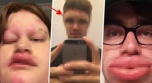 12 печальных раз, которых аллергия застала врасплох и кардинально изменила лица (14 фото)
