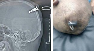 Эти шокирующие кадры показывают голову подростка, в которой после драки оказался ключ (6 фото)