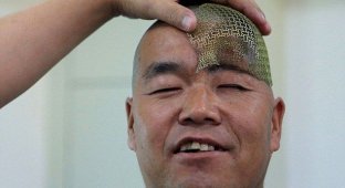 Врачи распечатали китайскому фермеру новый череп (5 фото) (жесть)