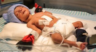 Шок: индийские врачи сделали операцию мальчику, родившемуся с четырьмя ногами! (8 фото)