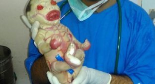 В Индии родилась девочка, на которой почти нет кожи (4 фото)