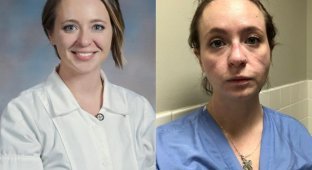 Медсестра Кэтрин Айви показала, как ее лицо изменила работа в больнице за полгода пандемии коронавируса (6 фото)