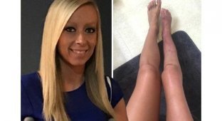Женщина ампутировала свою ногу, которую скрывала от взглядов посторонних 20 лет (8 фото)