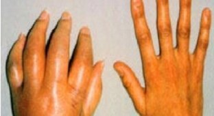 10 страшных болезней, с которыми не хотят связываться даже медики (11 фото) (жесть)
