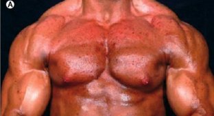 Вот что стеройды делают с телом "спортсмена"(3 фото)(жесть дня)