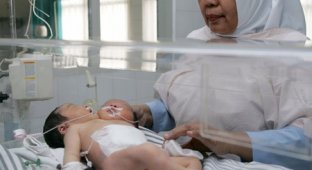 В Индонезии родился двухголовый ребенок (3 фотографии) Слабонервным не смотреть!