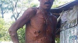 Мужчина из Бангладеш не ходит уже 40 лет из-за огромной опухоли (4 фото)