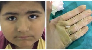 Восьмилетний мальчик проглотил игрушечную пищалку и выдавал постоянно игрушечный писк (3 фото + 1 видео)