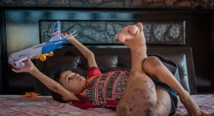 Нога индийского мальчика выросла вчетверо больше нормы (4 фото)