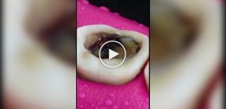 Лечение зуба наглядно