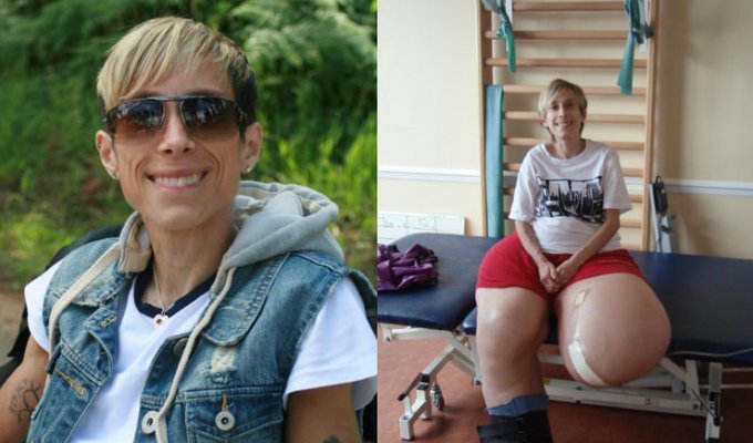Британка с редчайшим синдромом Протея рассказала свою жизнеутверждающую историю (8 фото)